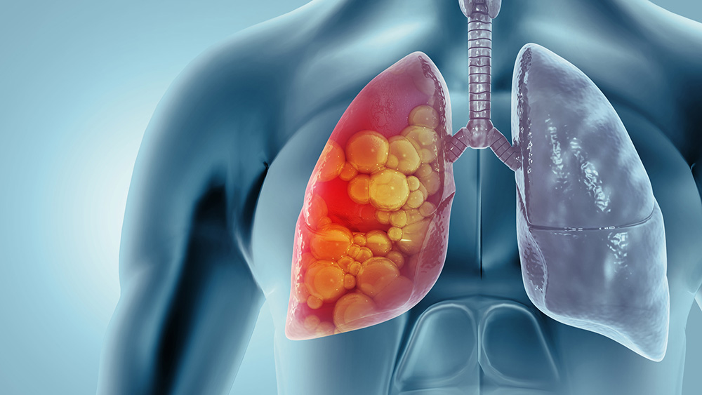 Graphic of lungs infected with Tuberculosis