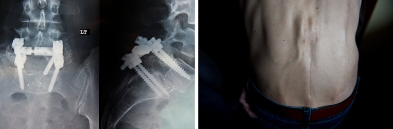 This composite image shows the X-ray of Cawthorn's lumbar interbody fusion surgery (left) and the spinal cord stimulator implanted in her back (right). The device helps to ease her pain.