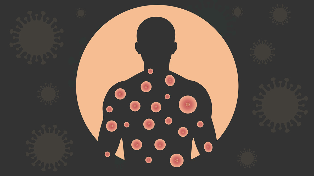 Graphic of body with monkeypox