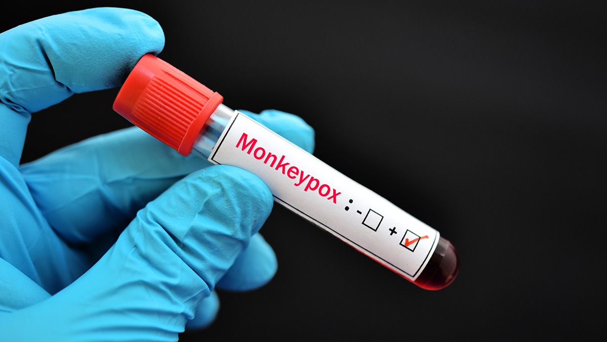 Gloved hand holding monkeypox positive vile