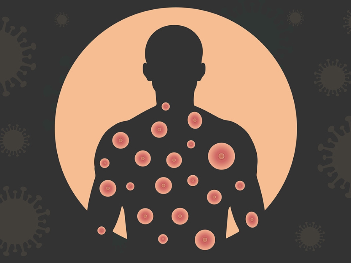 Graphic of mpox in human respiratory system