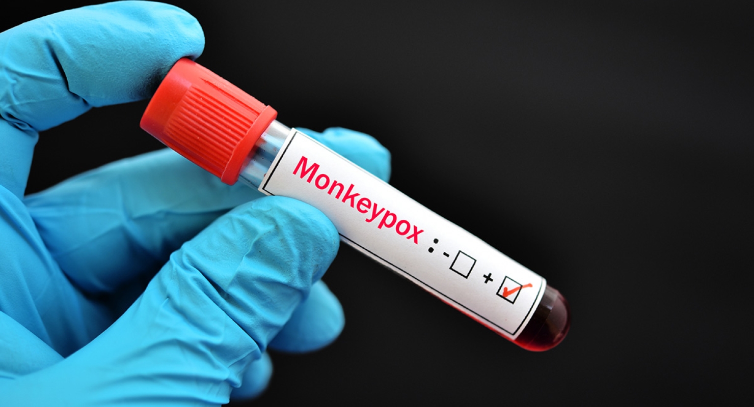 Gloved hand holding positive monkeypox vile