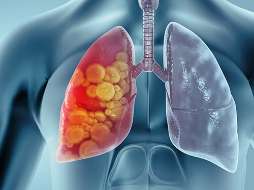 Graphic rendition of Tuberculosis in lungs